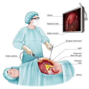 Laparoscopic Surgery